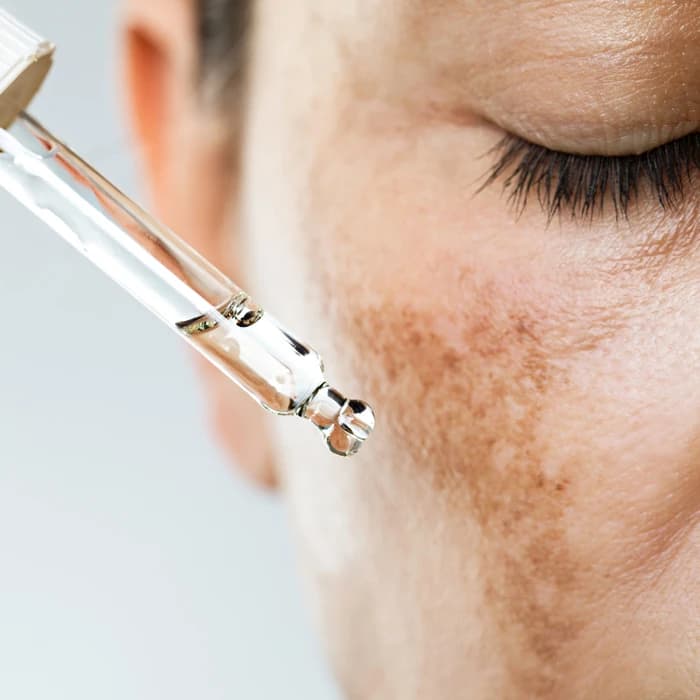 Hyperpigmentation, Rosacea & Melasma