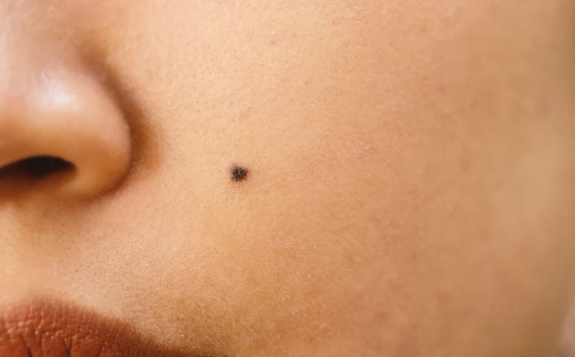 Skin Lesions & Mole Removals