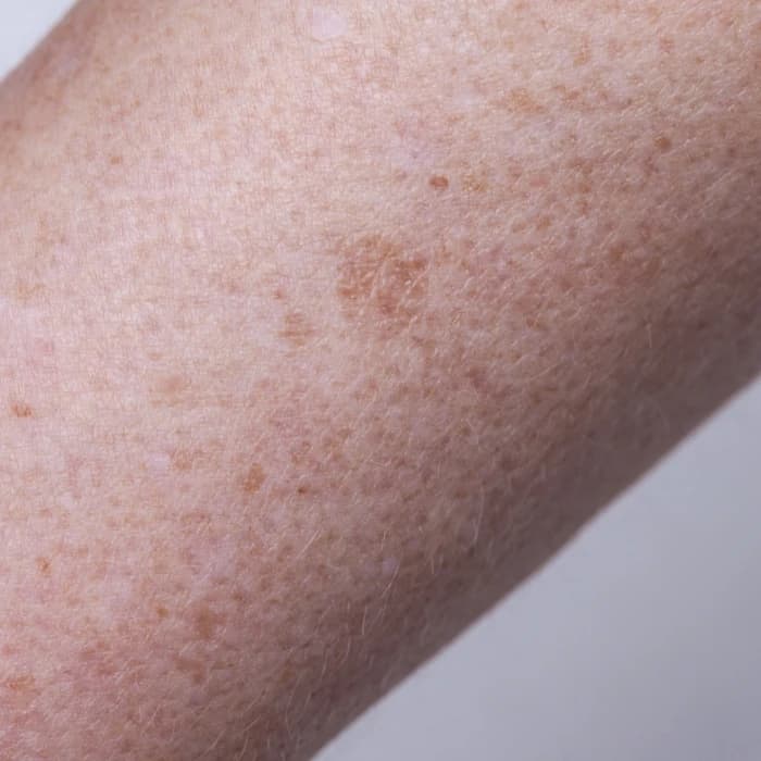 Sun Spots & Age Spots